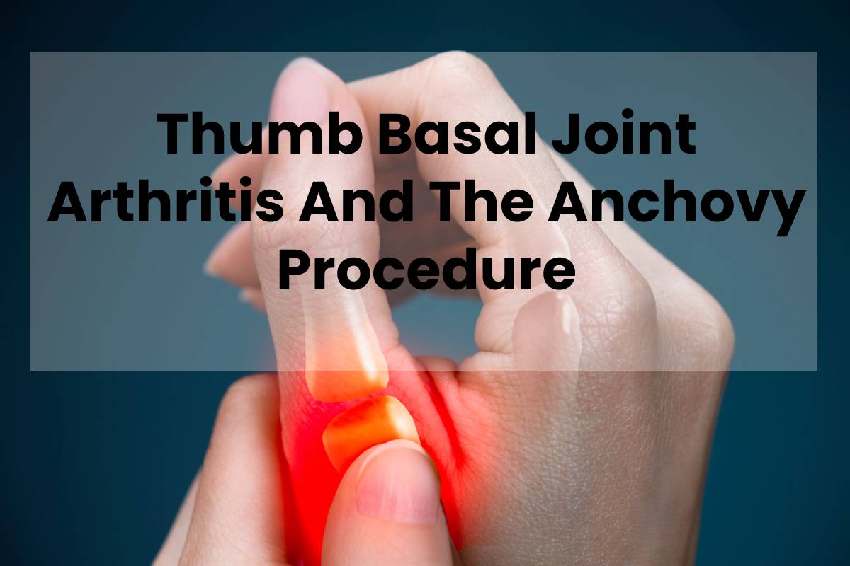 Thumb Basal Joint Arthritis And The Anchovy Procedure 2022